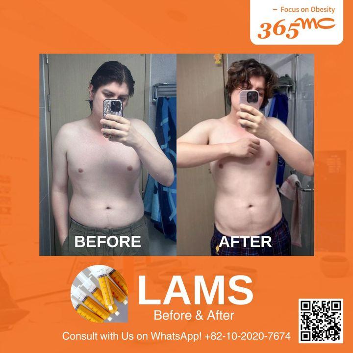 See the transformative results of our LAMS procedure in this before and after photo.