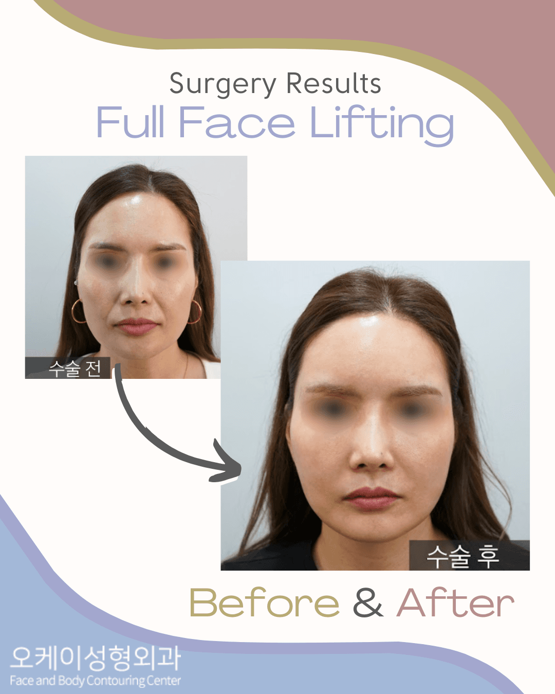Okay Plastic Surgery Clinic before and after image