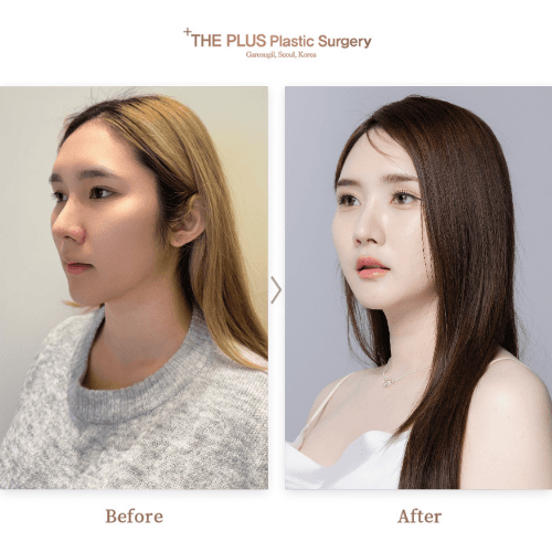 Endoscopic Forehead Lift & Fat Grafting & Zygoma Reduction
