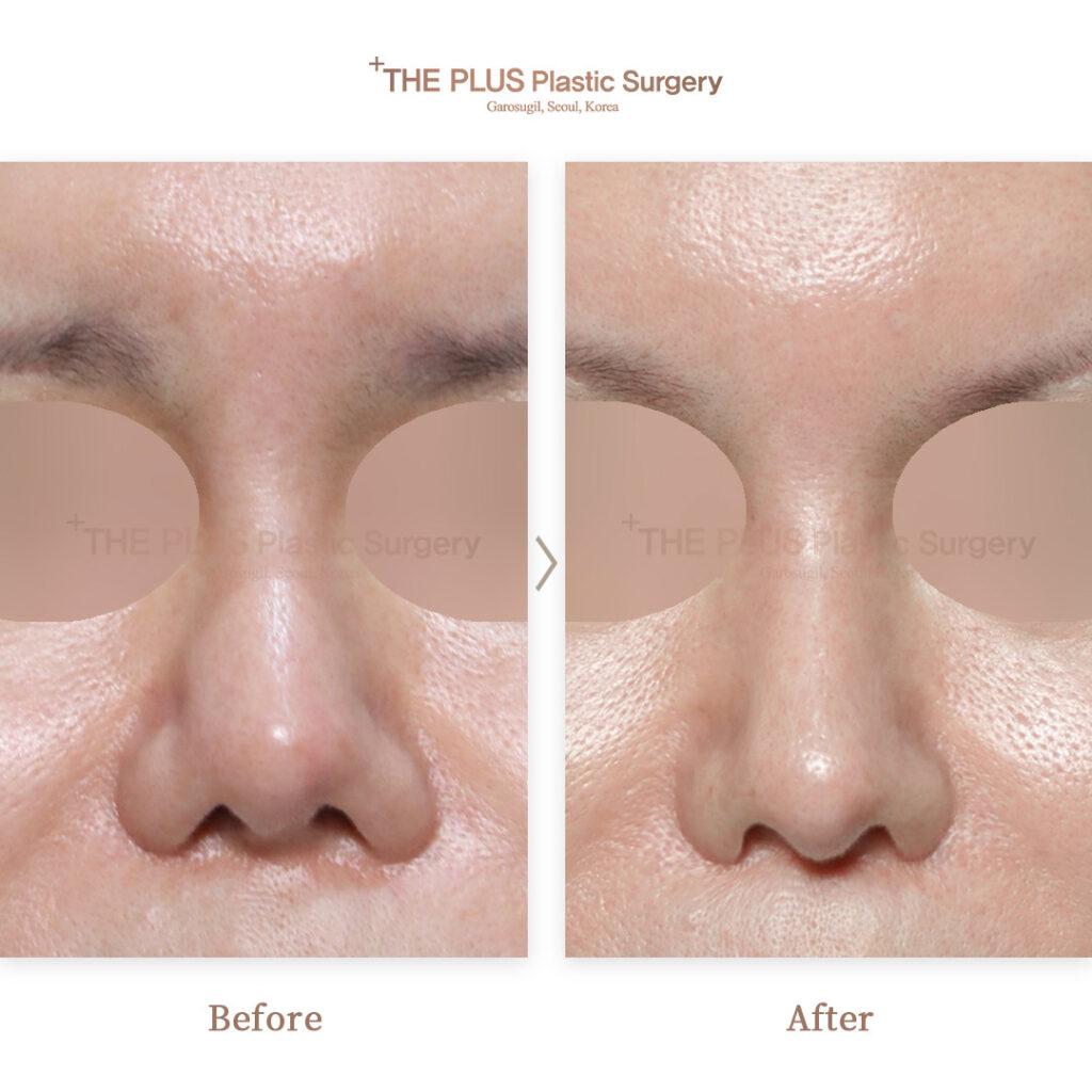 THEPLUS Plastic Surgery before and after image