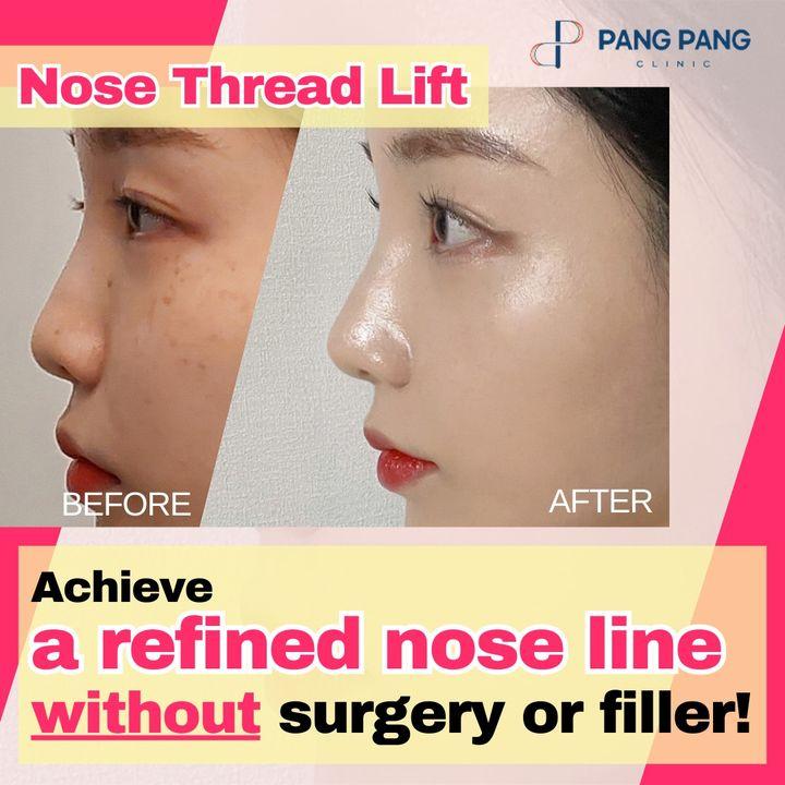 Redefine elegance with PangPang’s Nose Thread Lift. Discover the pathway to a refined nose profile, elegantly achieved without the need for surgery or fillers. Embrace your natural beauty, refined.
