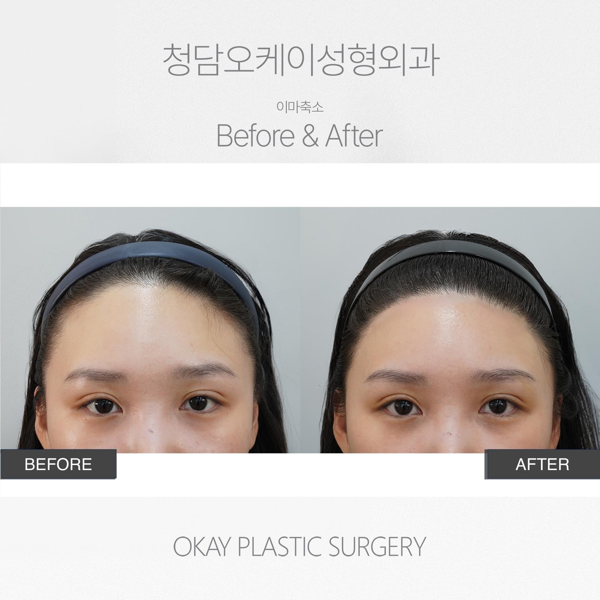 Okay Plastic Surgery Clinic before and after image