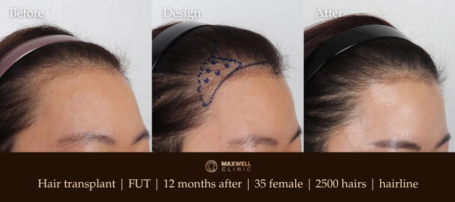 Female hairline