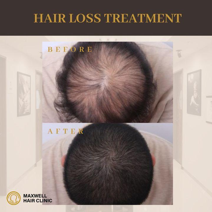 before and after photo of hair loss treatment