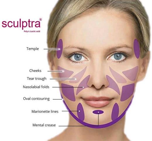 Sculptra