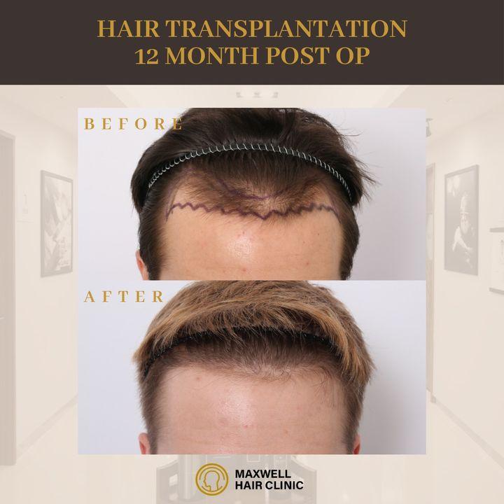 before and after photo 12 months after hair transplant