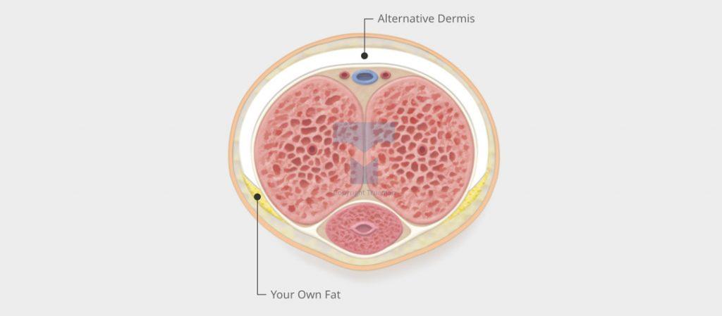 PE (Premature Ejaculation)