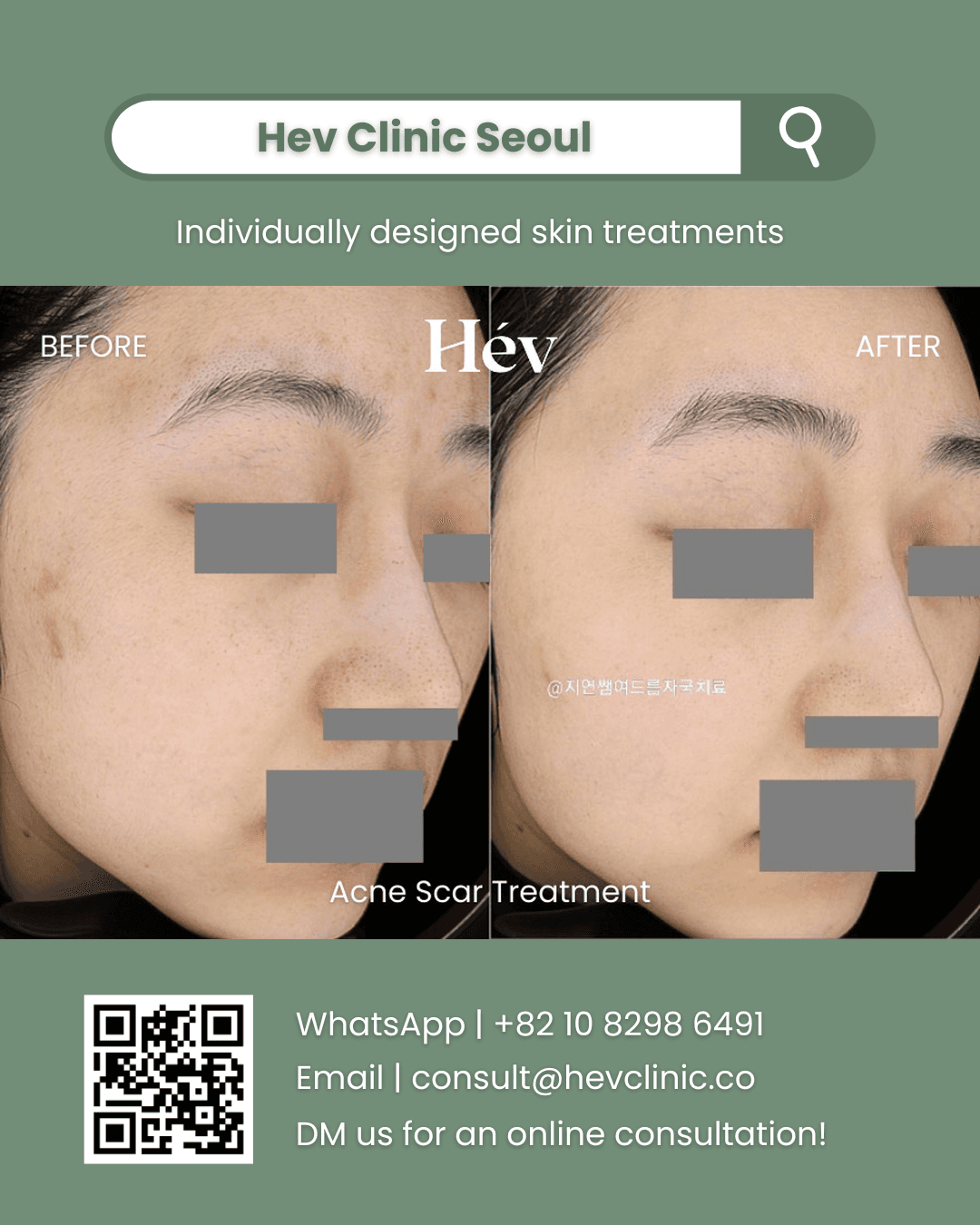 Acne Scar Treatment, Acne Treatment