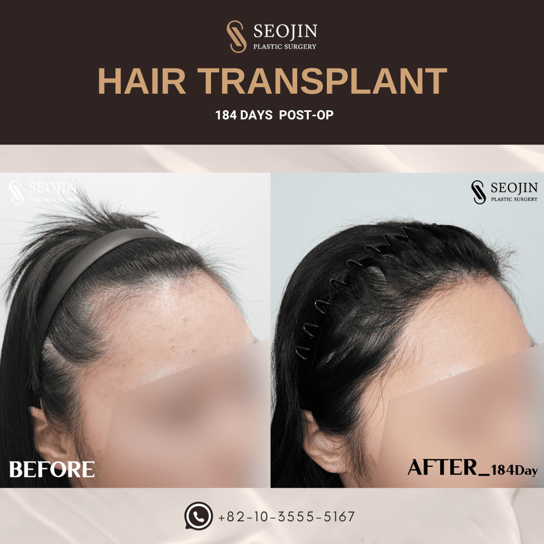 Hair Transplant
