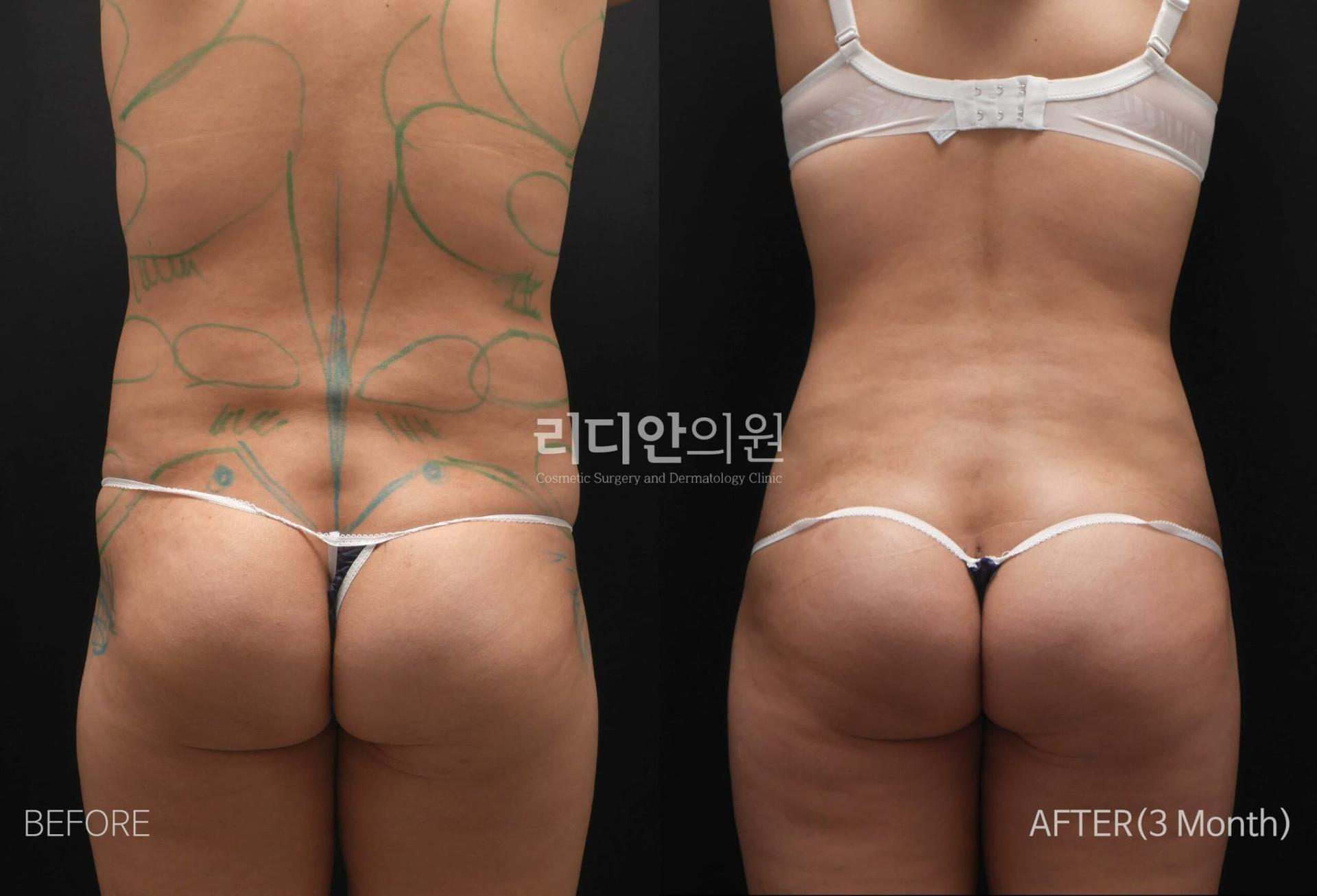 Lydian Plastic Surgery Clinic before and after image