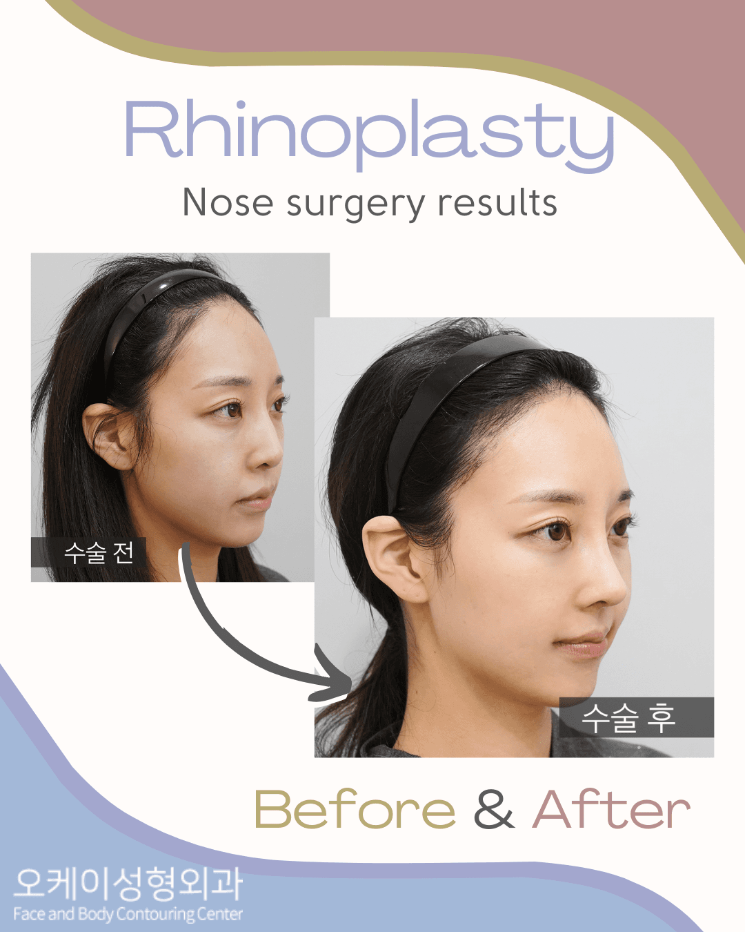 Okay Plastic Surgery Clinic before and after image