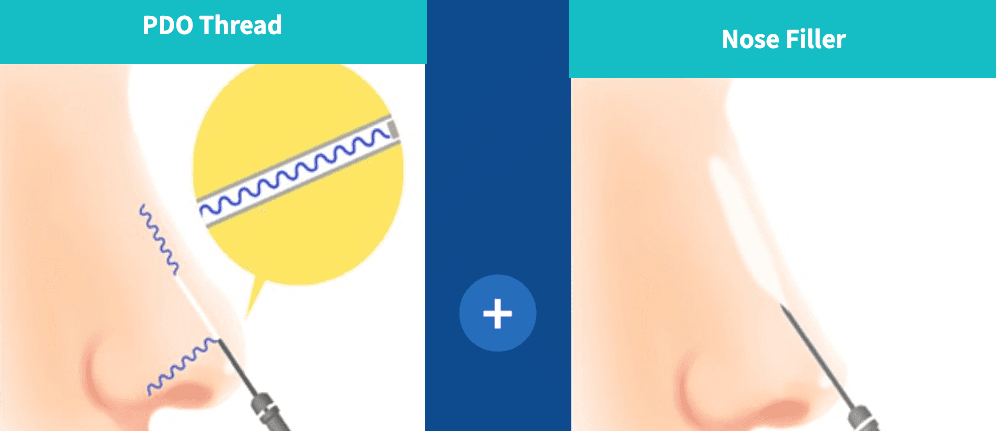 Nose Thread Lift