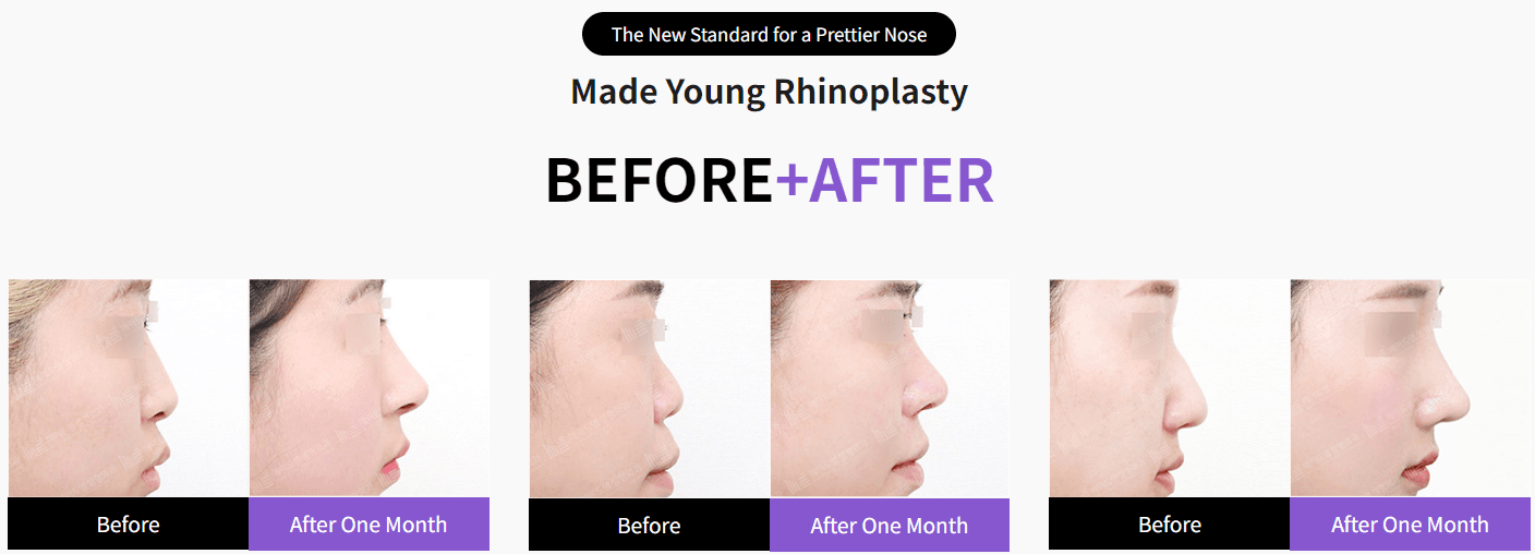 Rhinoplasty Before and after