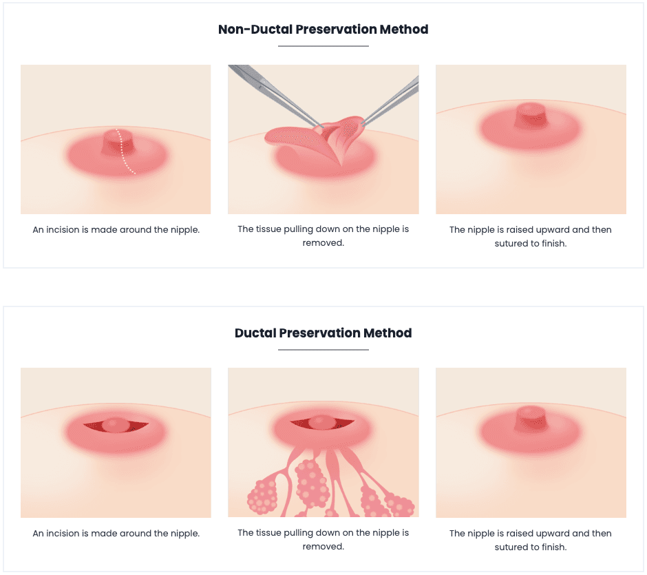 Areola Surgery, Nipple Surgery