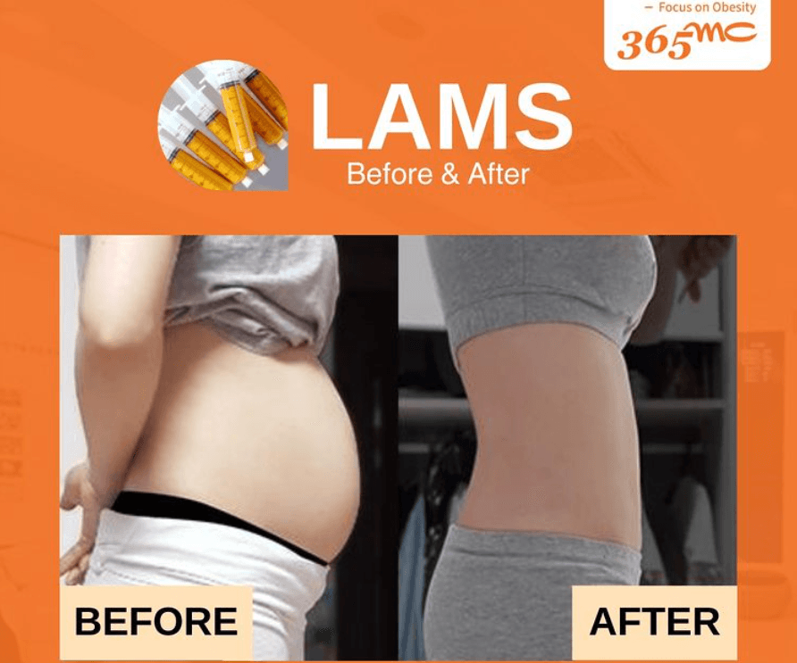 LAMS before and after