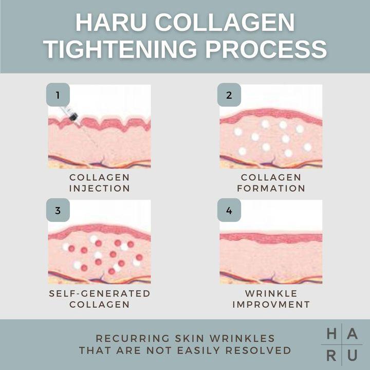 Collagen Booster, Collagen injection