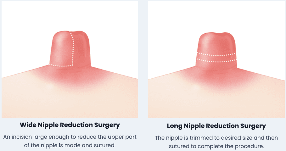 Nipple Surgery