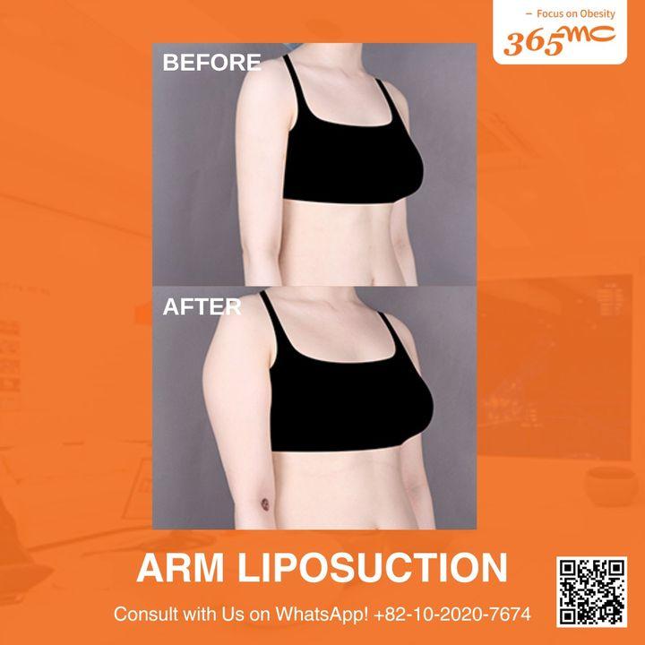 Achieve beautifully sculpted arms with our ARM LAMS procedure. Minimal invasiveness, maximum results. See the difference in our before and after photos.