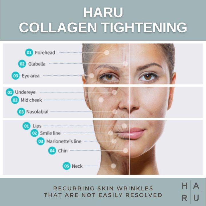 Collagen Booster, Collagen injection