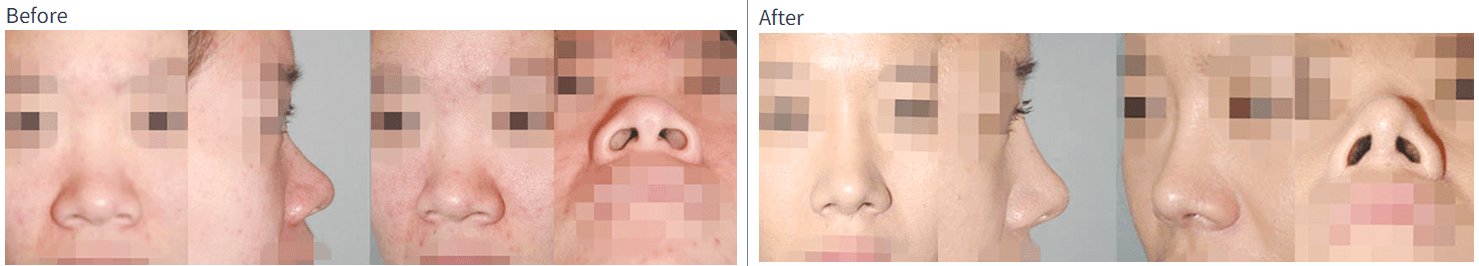 alar reduction korea before after