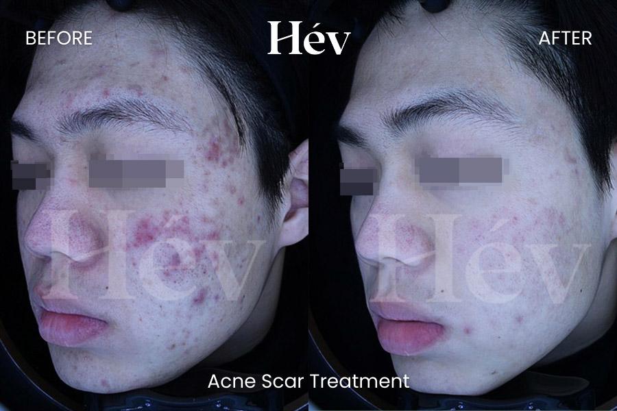 Acne Scar Treatment