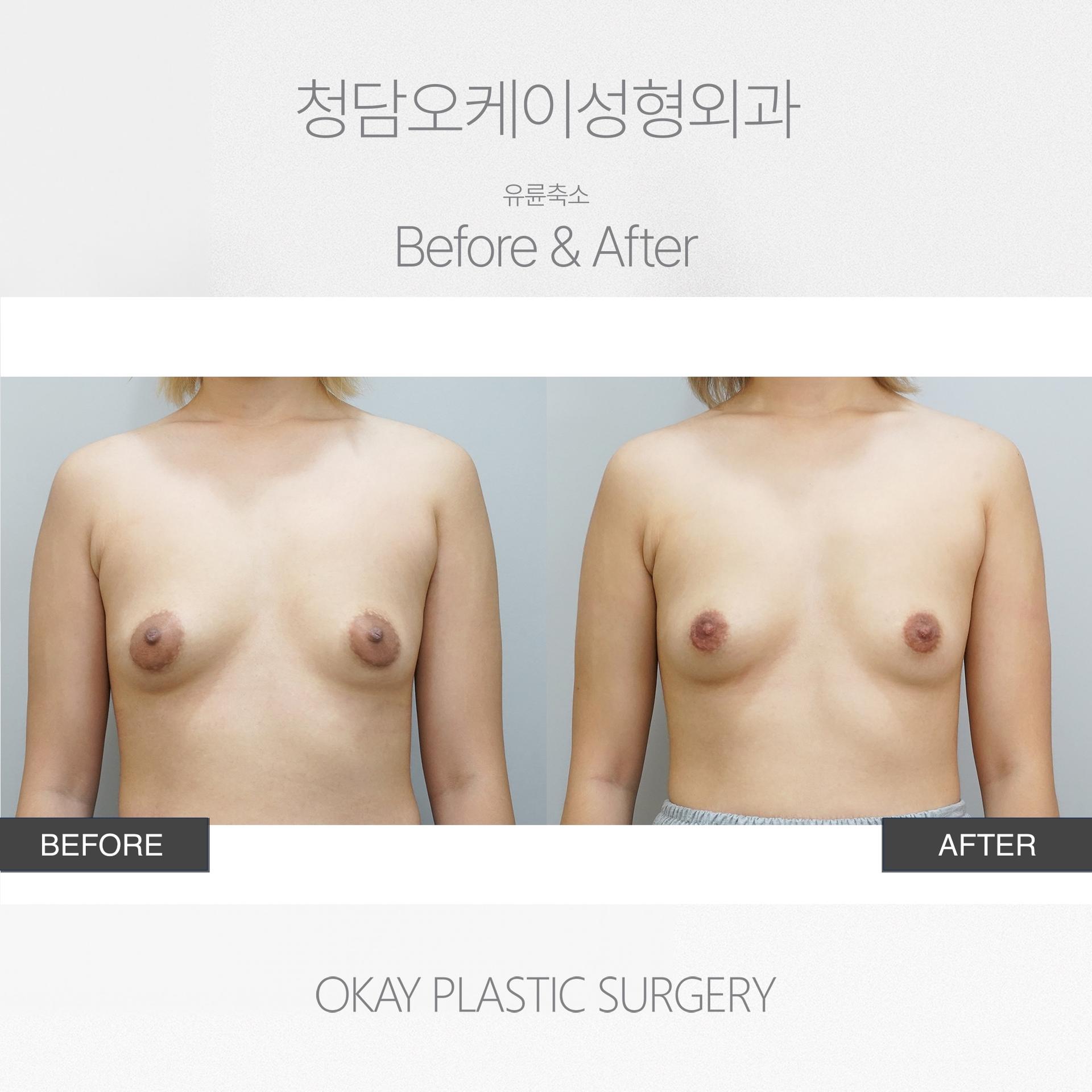 Okay Plastic Surgery Clinic before and after image