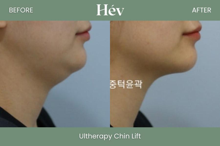 Ultherapy Chin Lift