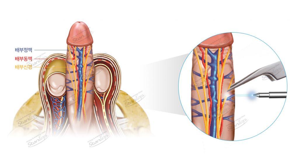 PE (Premature Ejaculation)