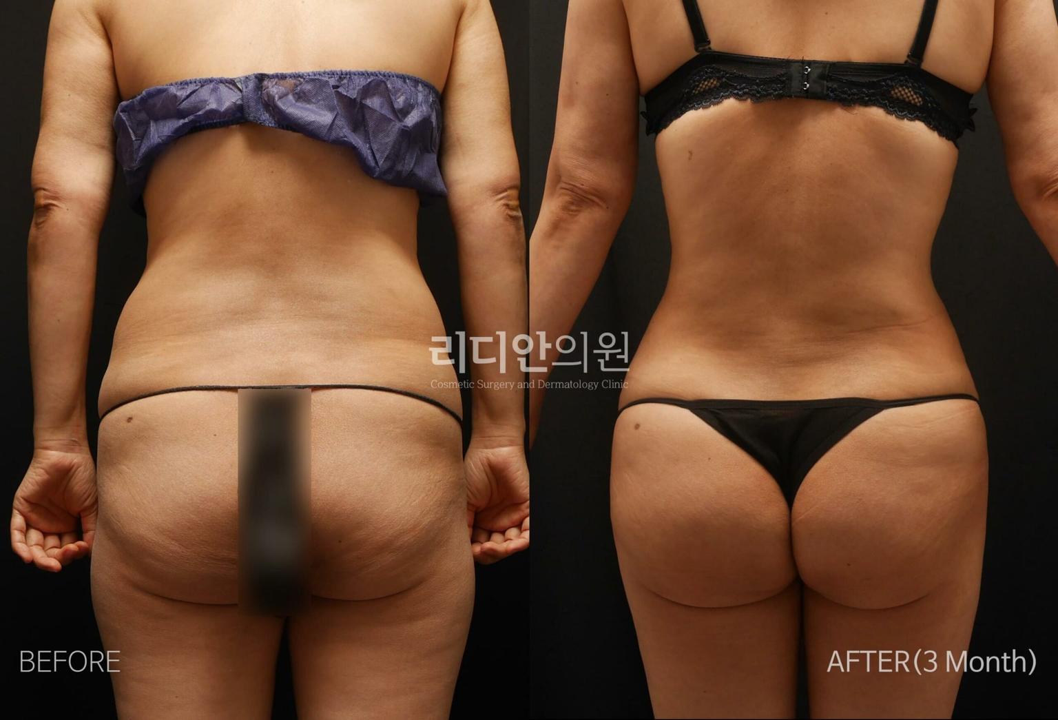 Lydian Plastic Surgery Clinic before and after image