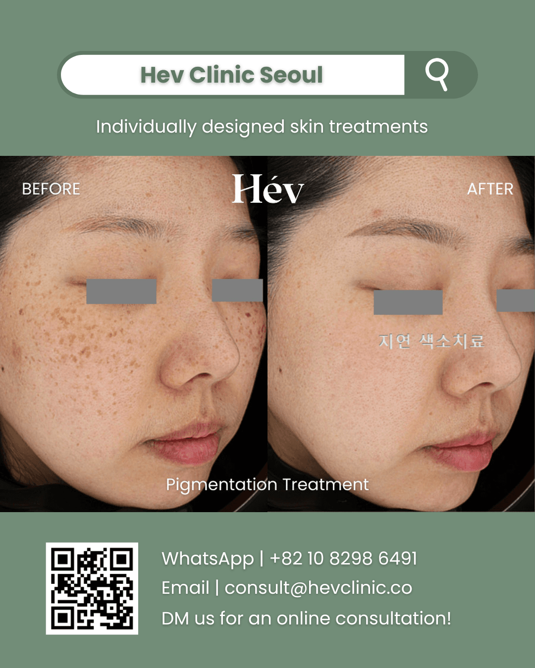 Pigmentation Treatment