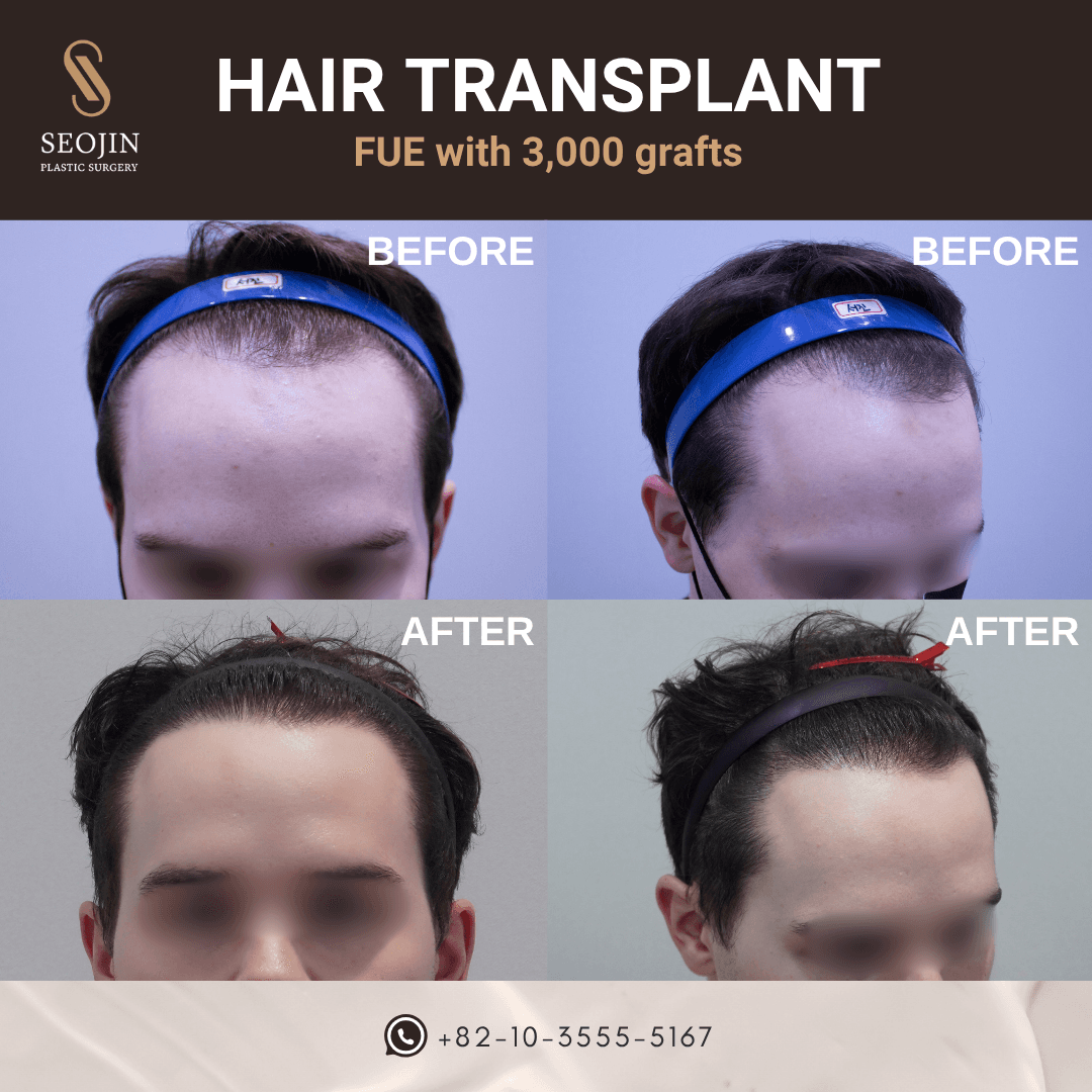 HAIR TRANSPLANT FUE with 3,000 grafts