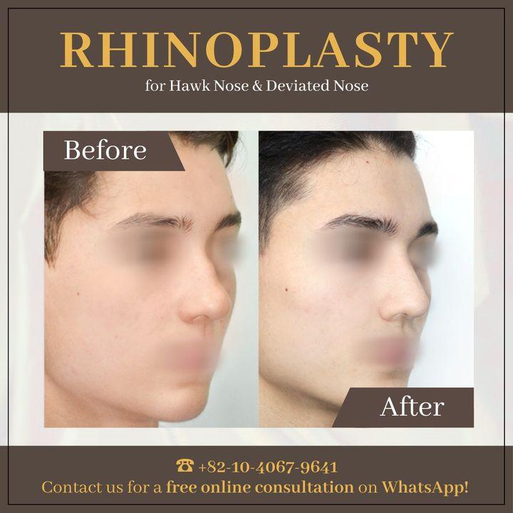 Correct and perfect your profile with rhinoplasty. Our before and after photos showcase the precision of our techniques.