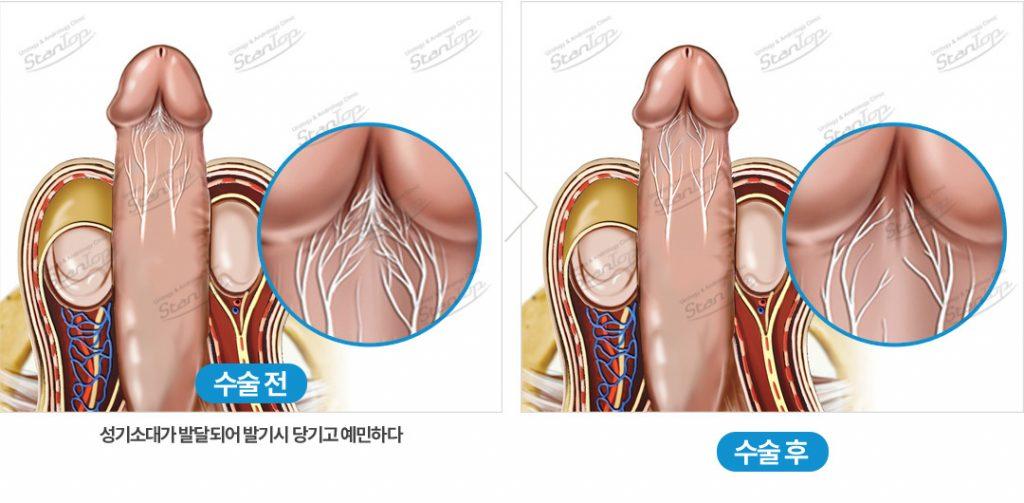 PE (Premature Ejaculation)