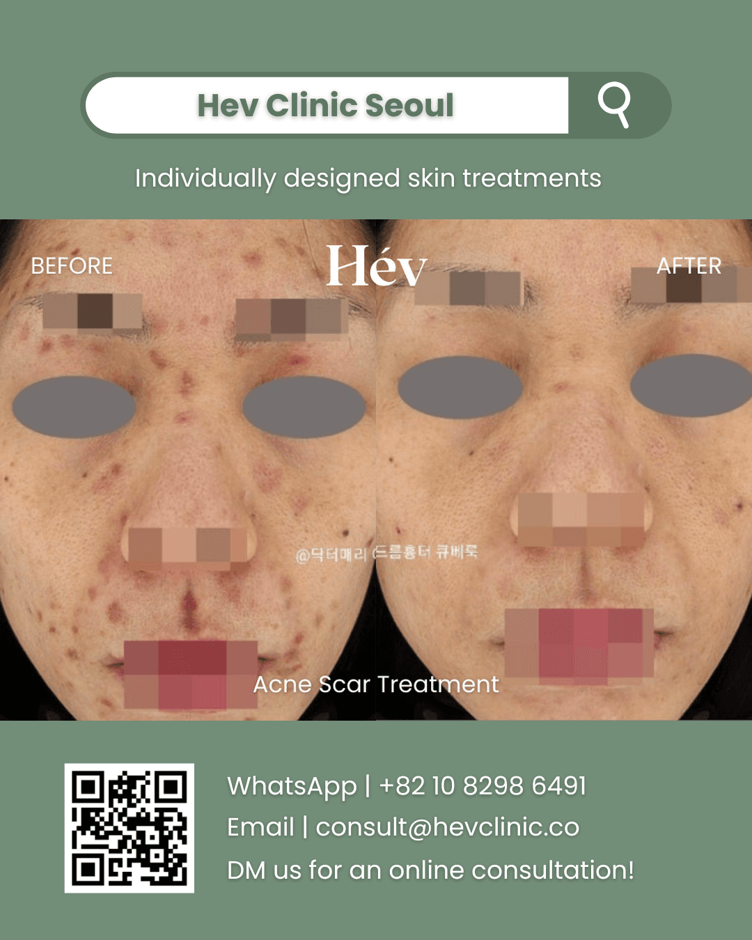 Acne Scar Treatment, Acne Treatment