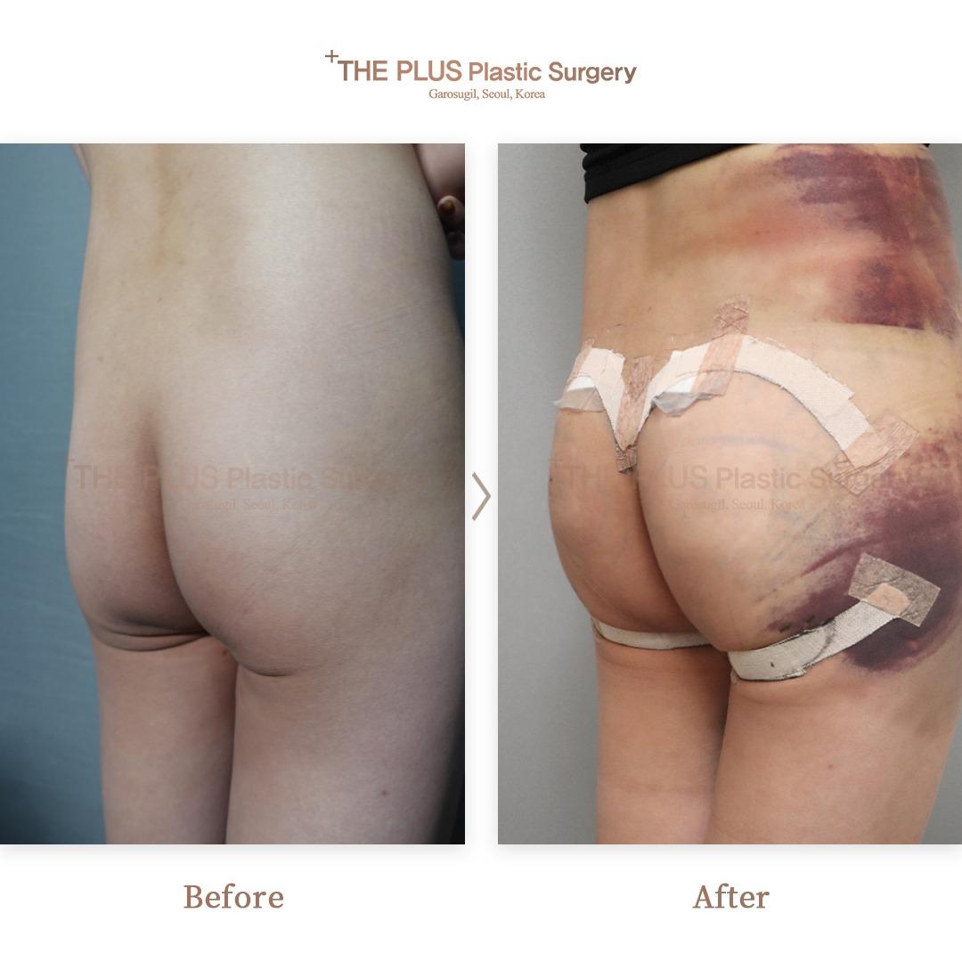 THEPLUS Plastic Surgery before and after image